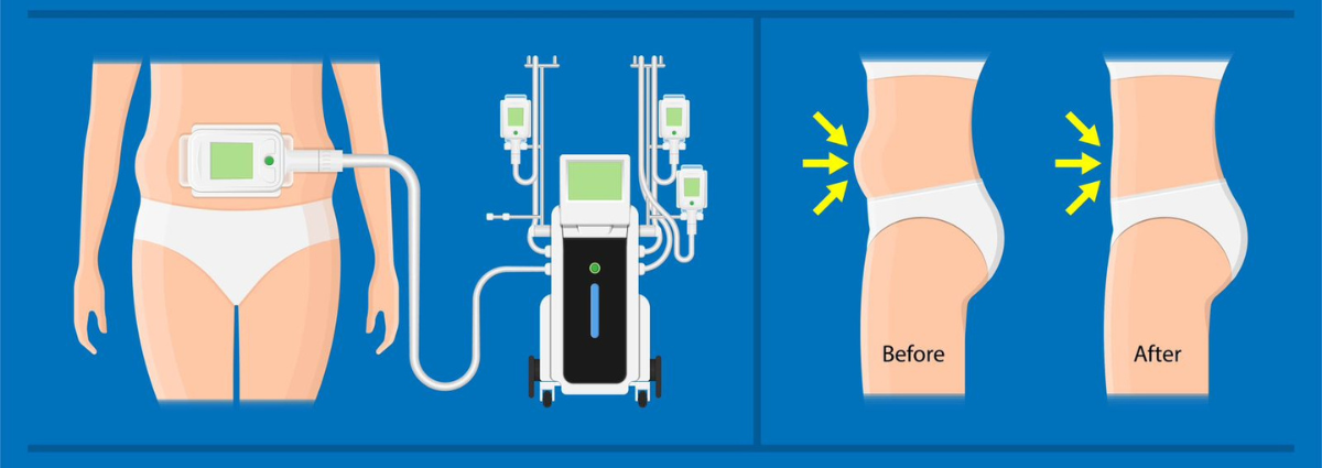 Fat Freezing in Ras Al Khaimah