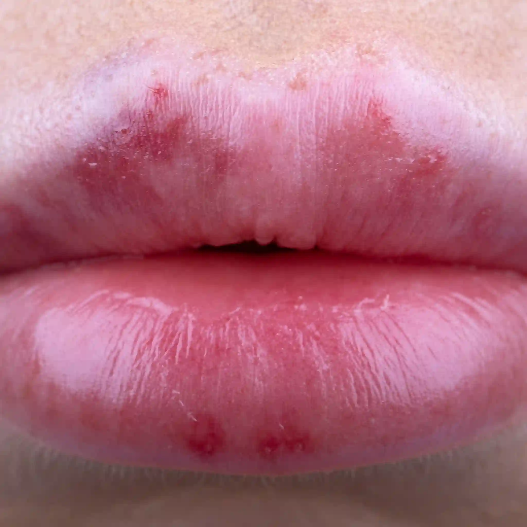 bruise after b12 injection How to Reduce Bruising After Injectable Treatments main image 0